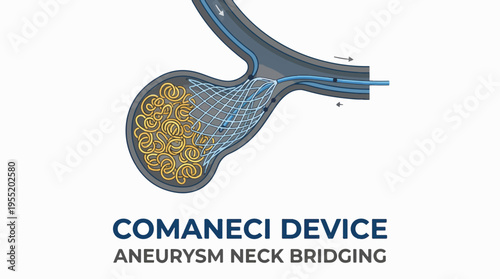Illustration of the Comaneci device used to bridge an aneurysm neck, deploying coils within the aneurysm sac for treatment.
