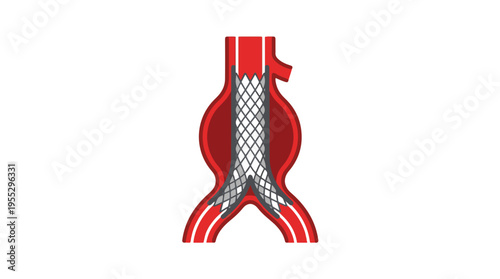 An illustration of an endovascular stent graft placed within an abdominal aortic aneurysm (AAA) to reinforce the weakened vessel wall and restore healthy blood flow.