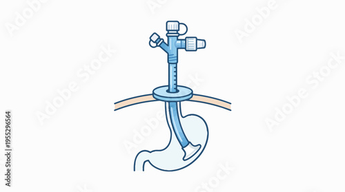 Medical illustration of a gastrostomy tube (G-tube) inserted through the abdominal wall into the stomach. It shows an external port and an internal retention device, typically for enteral fe