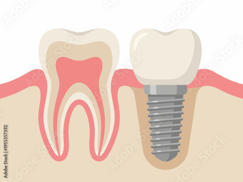 This detailed image shows a dental implant next to a healthy tooth, representing modern dentistry advancements that enhance oral health and patient confidence in smiles.