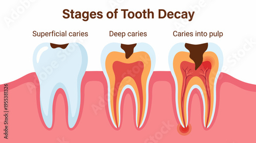 A clear and informative diagram illustrating the stages of tooth decay, providing essential insights into oral health and the progression from superficial caries to pulp infection.