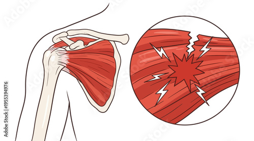 This image illustrates the shoulder anatomy, showing muscles and highlighting a tear, emphasizing the importance of understanding shoulder injuries for better recovery.