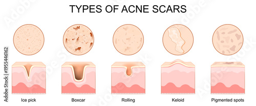 Types of acne scars. Cross section of human skin after treatment acne pimples.