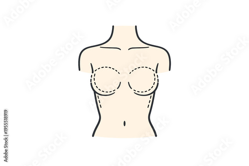Female Torso with Breast Augmentation Marks – Plastic Surgery Vector Illustration