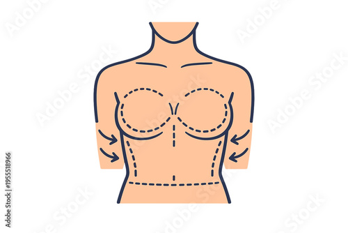 Female Torso with Breast Augmentation and Lift Incision Markings, Plastic Surgery Preoperative Diagram, Mastopexy with Implants Lines Illustration