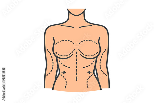 Female Torso with Surgical Markings for Breast Lift Mastopexy Procedure, Plastic Surgery Incision Lines Diagram