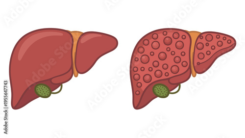 Healthy liver compared to diseased liver with cirrhosis
