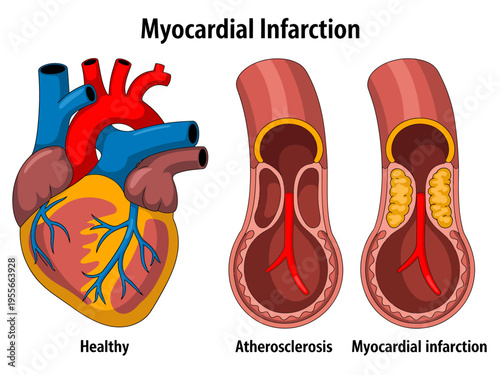 Healthy heart and arteries compared to atherosclerosis and myocardial infarction