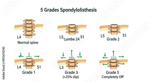 Detailed medical illustration demonstrating the five grades of spondylolisthesis in the human spinal anatomy.