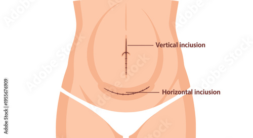 Medical illustration depicting vertical and horizontal cesarean section incisions on a woman's lower abdomen