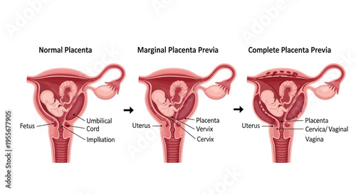 Understanding different types of placenta previa, including normal, marginal, and complete conditions during pregnancy