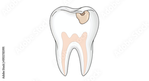 Illustration of a molar tooth with a cavity on a white background