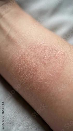 Close-up of a person's arm showing a red, itchy rash with small bumps and dry, flaky skin, possibly indicating a skin condition like eczema or chickenpox.
