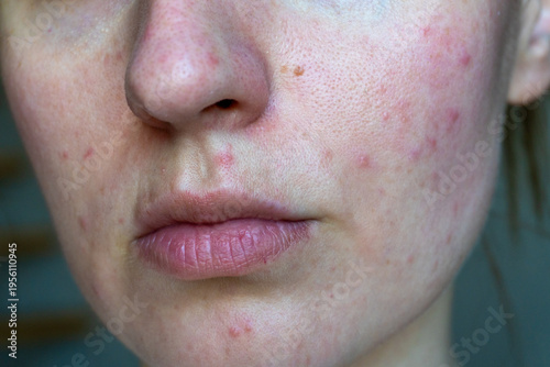 Принти на полотні Close up of young woman face with visible acne, redness and uneven skin texture