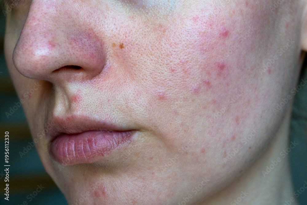 Αυτοκόλλητο Close up of young woman face with acne, redness and uneven texture