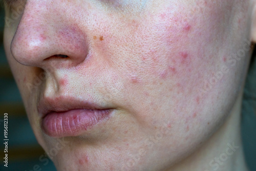 Φωτογραφία Close up of young woman face with acne, redness and uneven texture