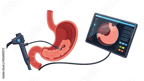 Detailed medical illustration shows a gastrointestinal endoscopy procedure with a monitor displaying internal stomach views.