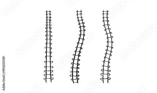 Scoliosis spine deformity