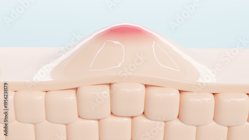 Fotografia 3D Illustration of skin inflammation, acne pimple on skin layers structure