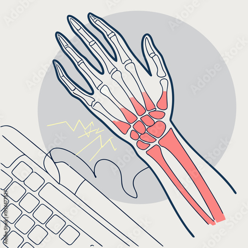An illustration of a hand with a skeletal structure highlighting painful wrist and forearm areas while typing on a keyboard