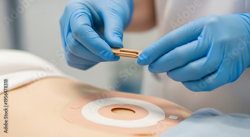 Medical professional applying ostomy bag adhesive seal to patient