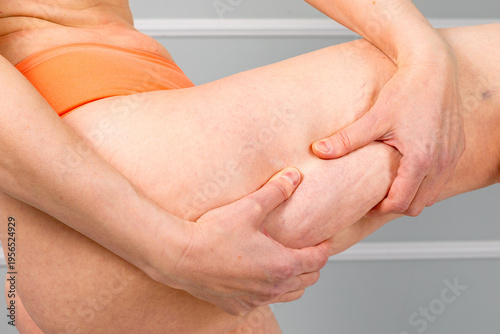 Fotografie Woman pinching excess skin on thigh to show cellulite