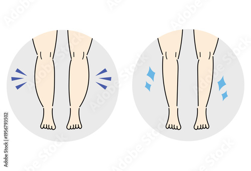 Leg Swelling Before And After Comparison Illustration Showing Improvement In Circulation And Body Care Concept For Beauty And Health