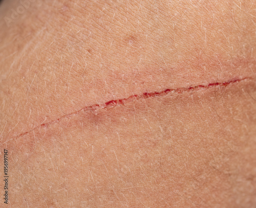 A person's arm has a red scar