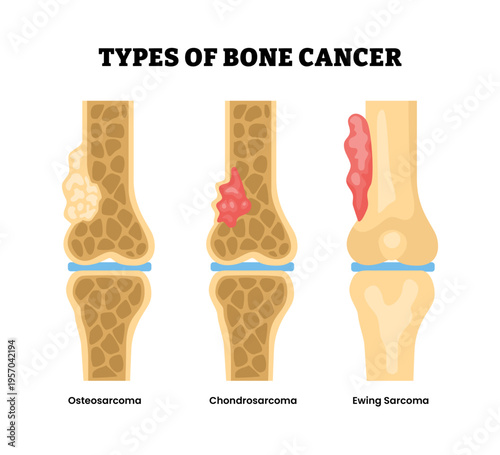 Different types of bone cancer types. Labeled osteosarcoma, chondrosarcoma, ewing sarcoma. Tumor cells with tissues mutation and inflammation. Flat vector illustration.