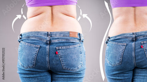 Before after weight loss, woman's back fat and muffin top reduction, concept of liposuction, diet progress and body contouring