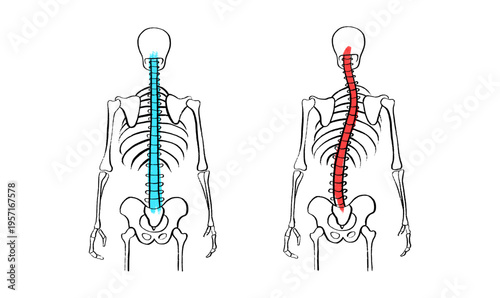 Scoliosis spine deformity