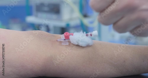 Close-up of a peripheral IV cannula inserted into a patient's arm with a protective cotton swab in a clinical setting