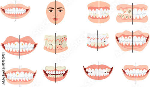 Flat vector illustration set of dental health comparison showing healthy white teeth versus decayed yellow teeth with cavities