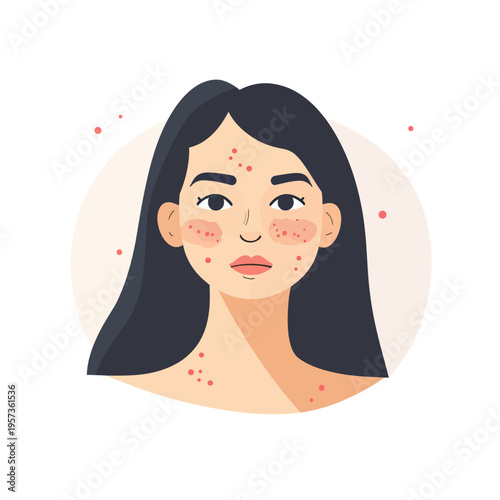 Young woman with visible red acne and pimples on face and neck in flat minimalist vector style skin condition illustration for skincare treatment concepts