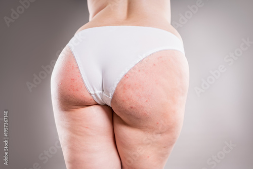 Female buttocks with red rash, bumps pimples. Folliculitis, keratosis pilaris, butt acne and dermatology skin problems