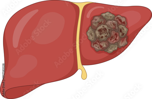 Vector medical illustration of hepatocellular carcinoma showing liver cancer tumor and diseased tissue
