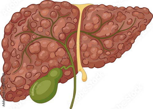 liver cirrhosis showing nodular texture and chronic liver disease