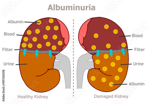 Albuminuria is a sign of kidney disease. Healthy kidneys prevent most of the albumin from passing through their filters and entering the urine.  Illustration vector