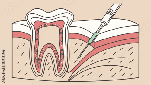 Dental anatomy diagram showing tooth layers and anesthetic injection for dental procedure