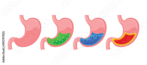 Four stomach illustrations with different colored contents inside