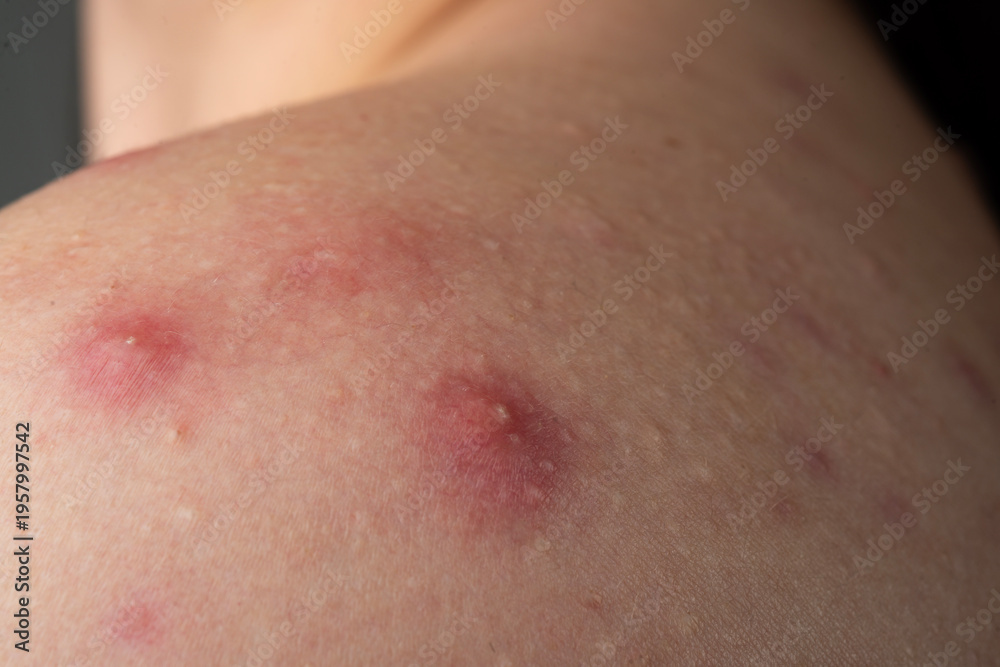 Fototapeta premium Acne on skin closeup photo. Irritated skin with pimples acne texture. Skin inflammation with whiteheads and acne detail. Detailed skin with acne.