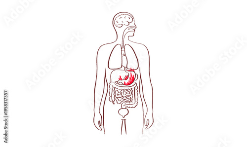 Gastroesophageal reflux pain