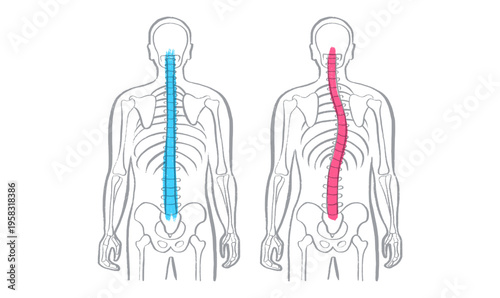 Scoliosis spine deformity