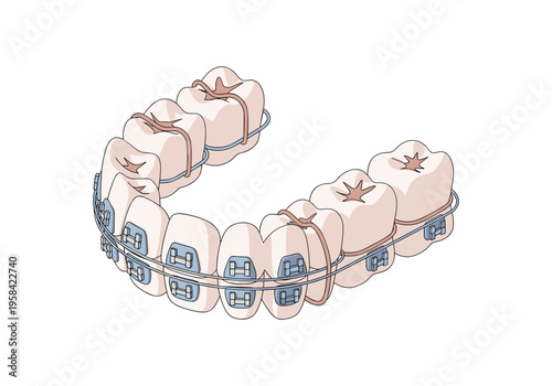 Dental braces and elastics for orthodontic tooth alignment and correction