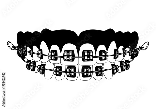 Close up of dental braces on teeth, a common orthodontic treatment for alignment