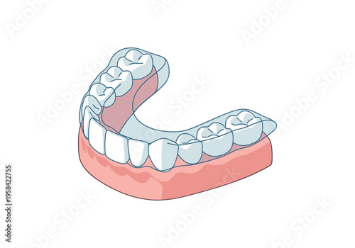 Clear dental retainer worn over teeth for alignment correction