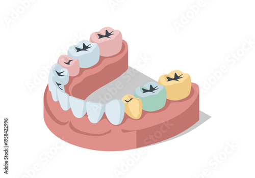 Colorful cartoon teeth model showing dental fillings and crowns in isometric view