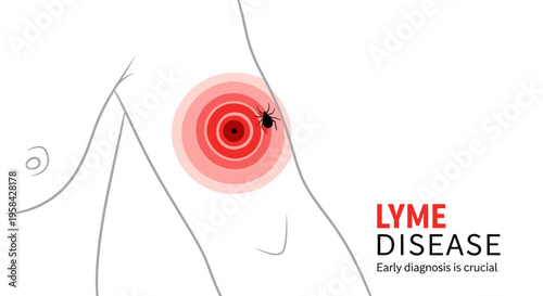 Lyme Disease Awareness Illustration with Tick Bite and Bullseye Rash (Erythema Migrans) on Human Skin.