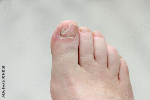 Fotografie toe nail filed smooth in preparation for reconstruction