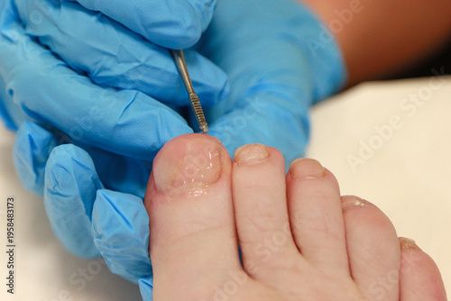 Foto toe nail reconstruction, forming elastic resin into shape